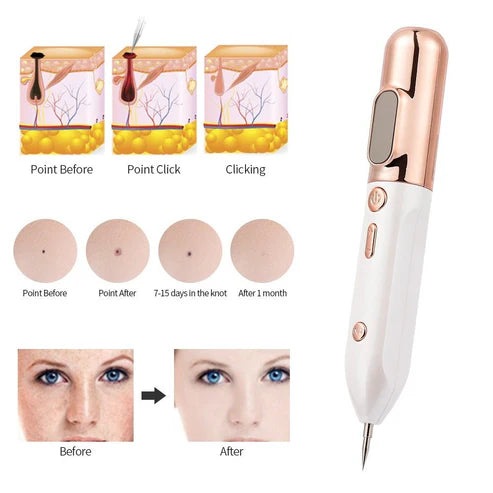 Acne & Mole Removal Beauty Instrument